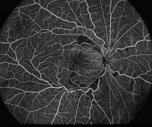 vasculitis retinal